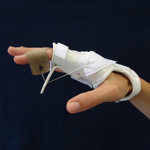 Dynamic Flexion Splint for Stiffness